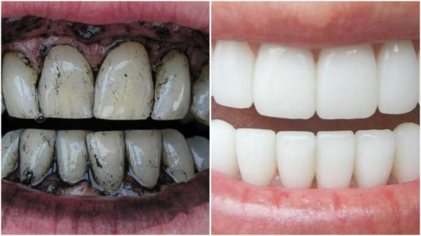 طريقة استخدام الفحم في تبيض الاسنان بسهولة