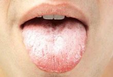 اسباب فطريات الفم