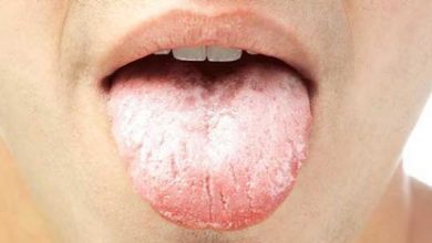 اسباب فطريات الفم