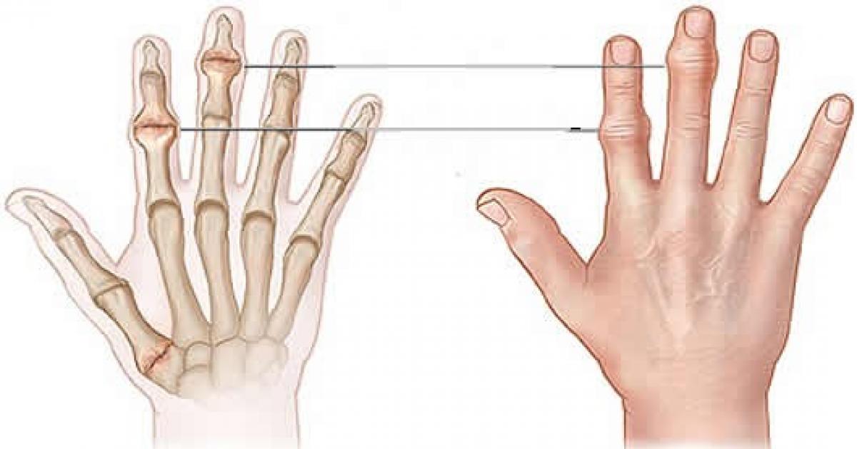 عاجل:: دراسة تحسم الجدل وتكشف نتائج فرقعة الأصابع
